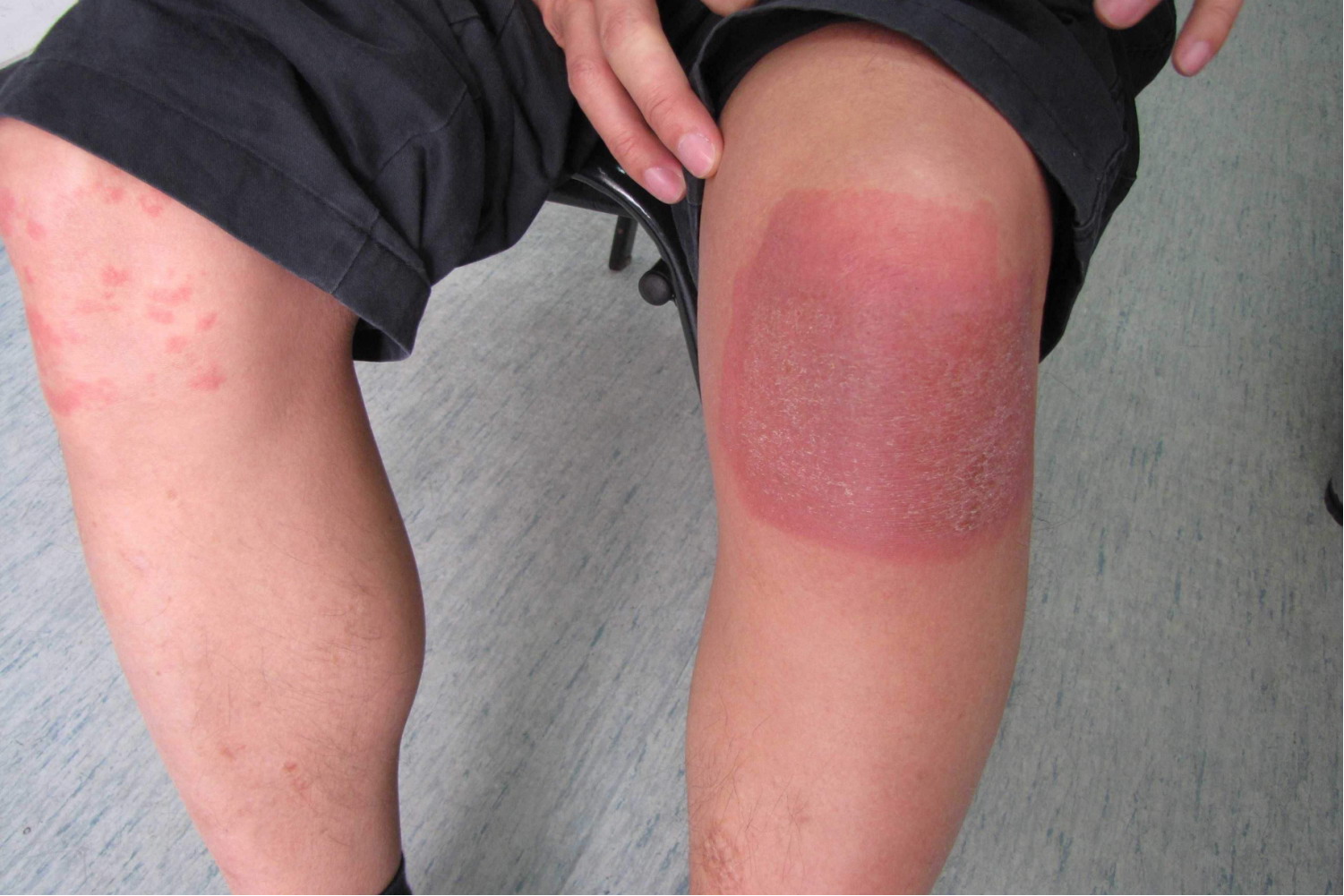 急性接触性皮炎图