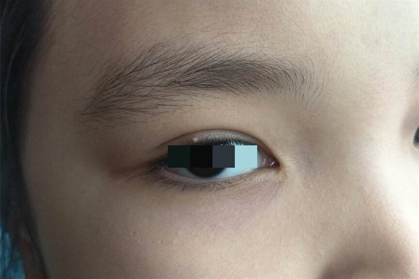 1,麦粒肿:俗称针眼,是眼睑腺体发生急性感染导致的疾病,发病初期可能