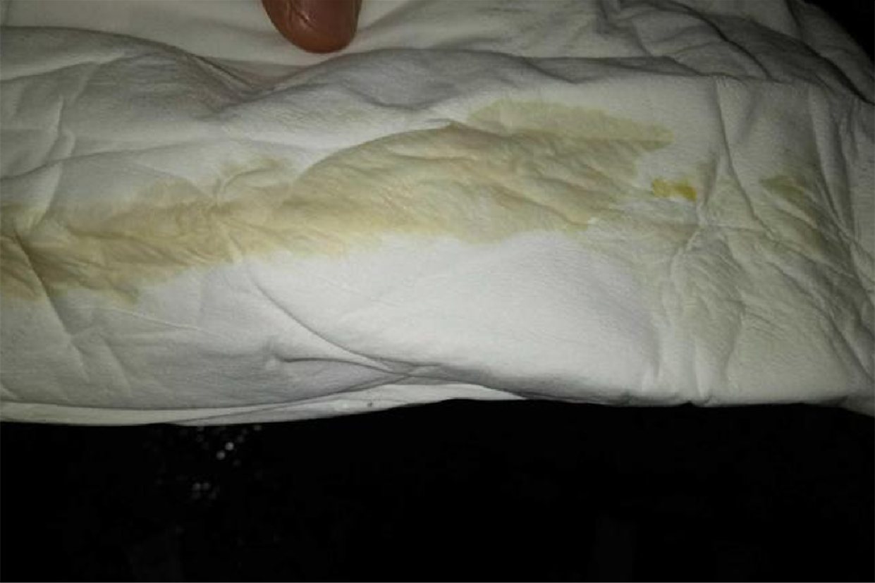 产后白色恶露图