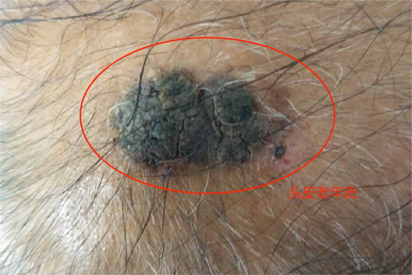 头皮老年疣图