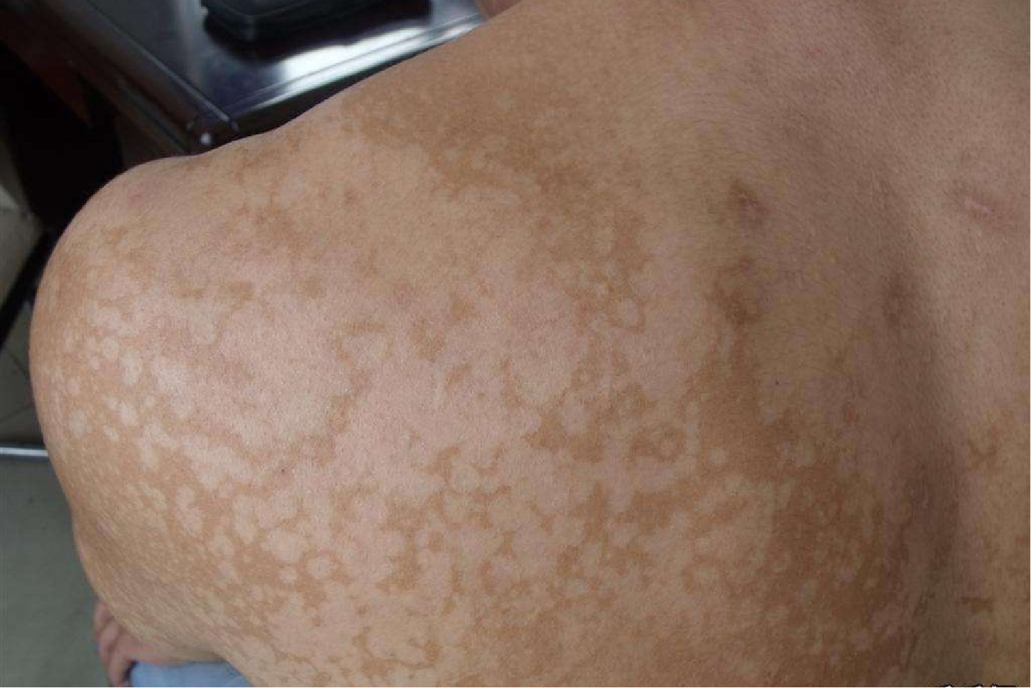 花斑癣严重图片