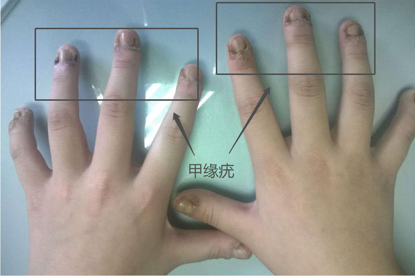甲缘疣图