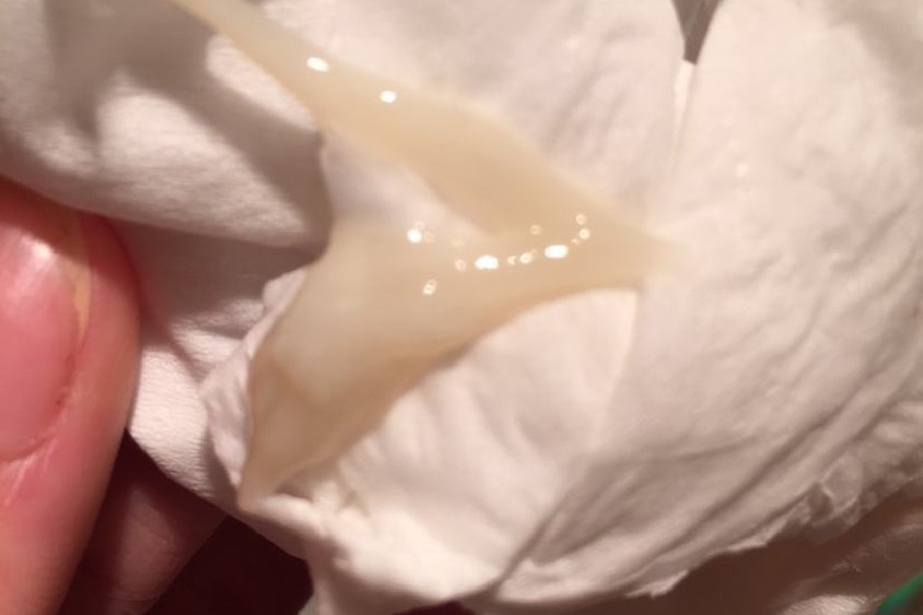 白色糊状分泌物图