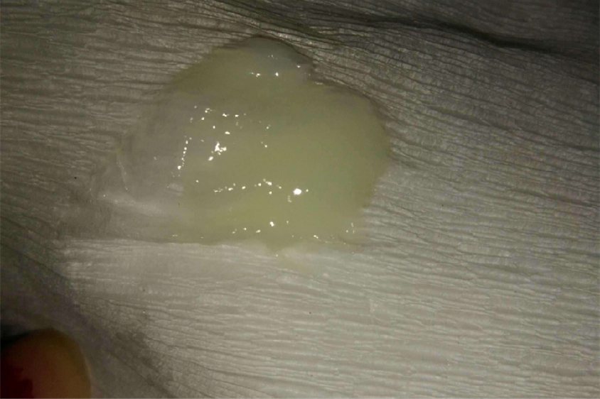 白带呈白色浆糊状图