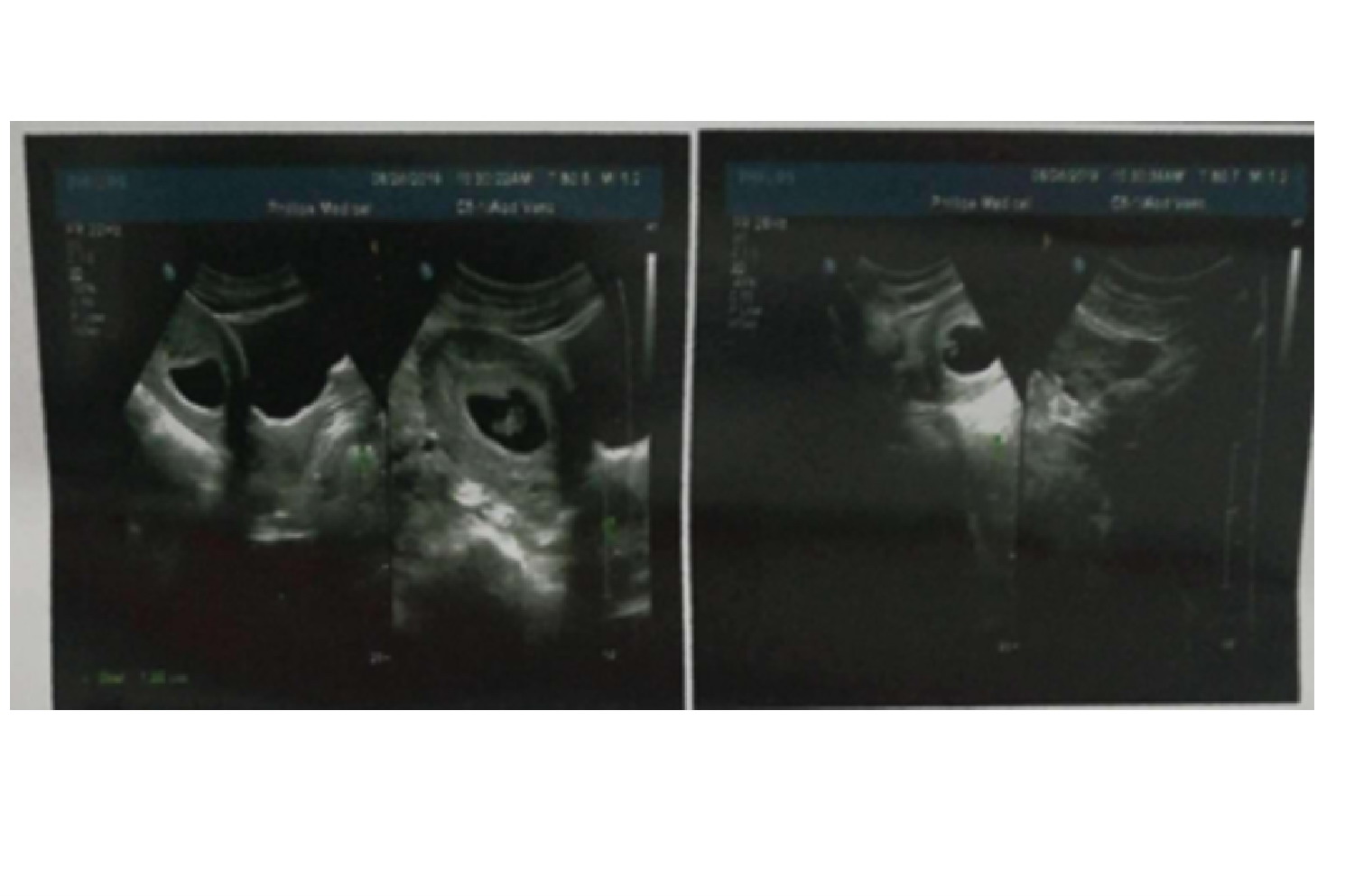 怀孕一个多月胎儿图