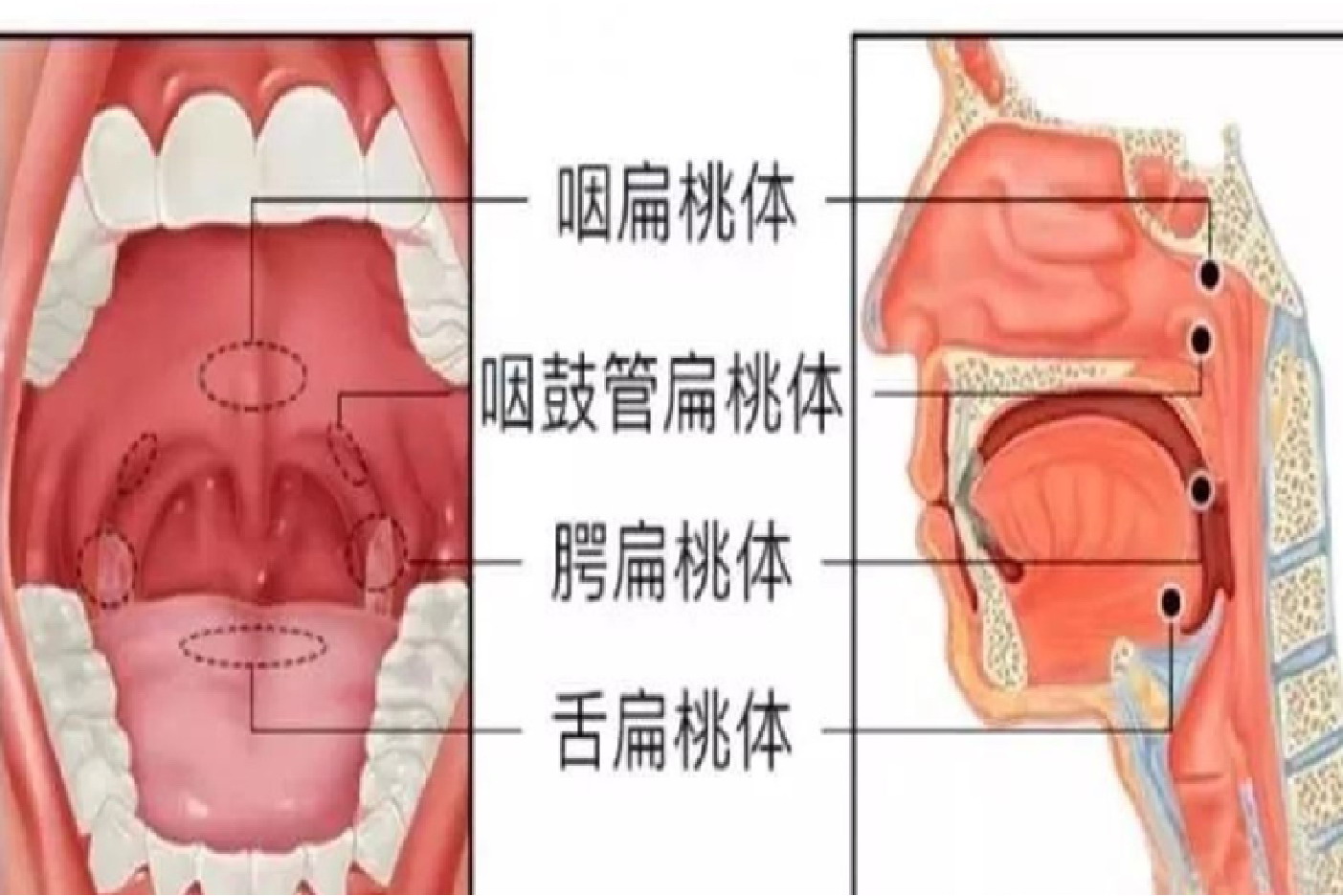 腭扁桃体咽扁桃体图片