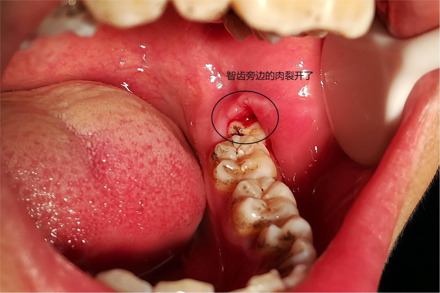 智齿旁边的肉裂开了图片