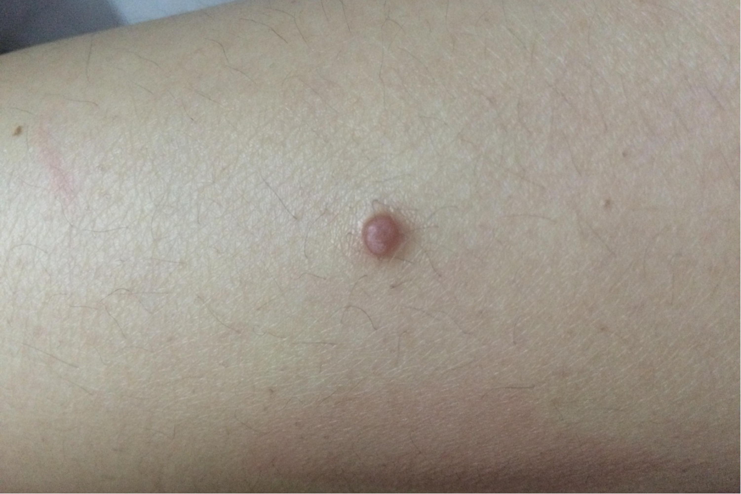 腿上长了个褐色硬疙瘩图片