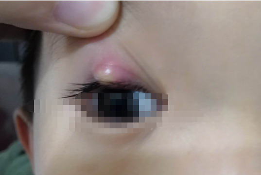 上眼睑腺炎图片