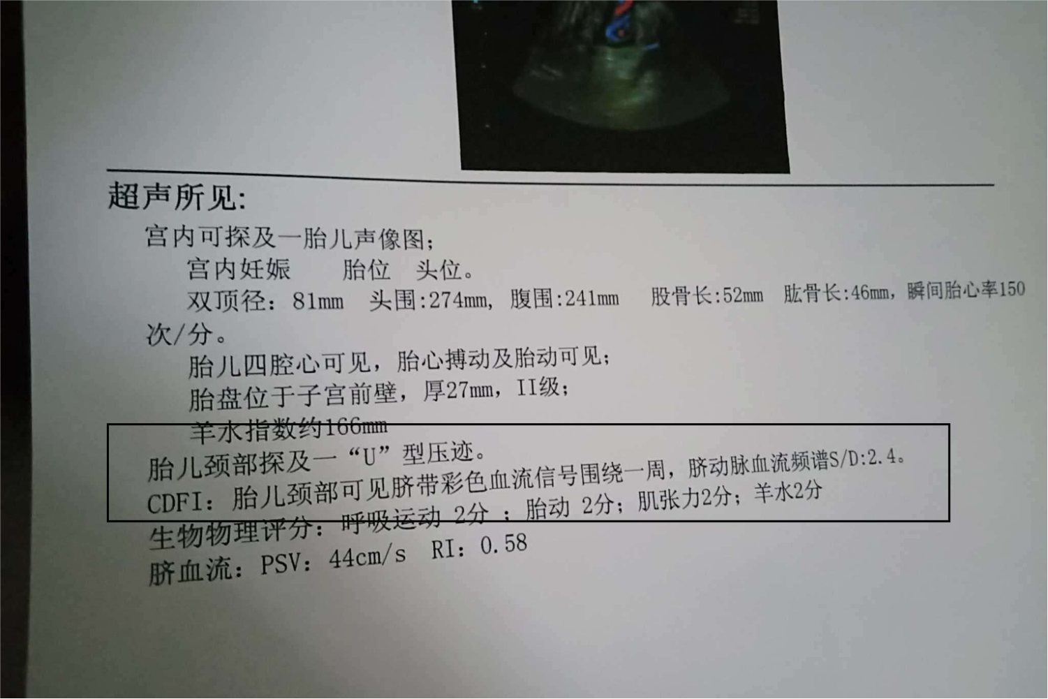 胎儿颈部U型压迹图