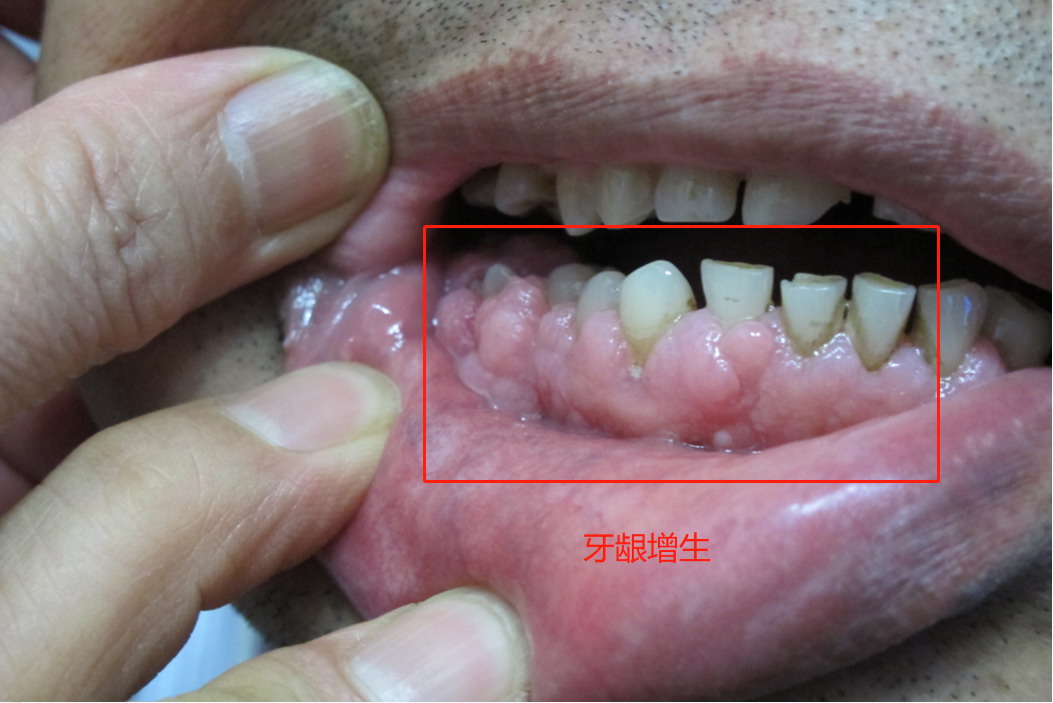 牙龈癌前兆图片