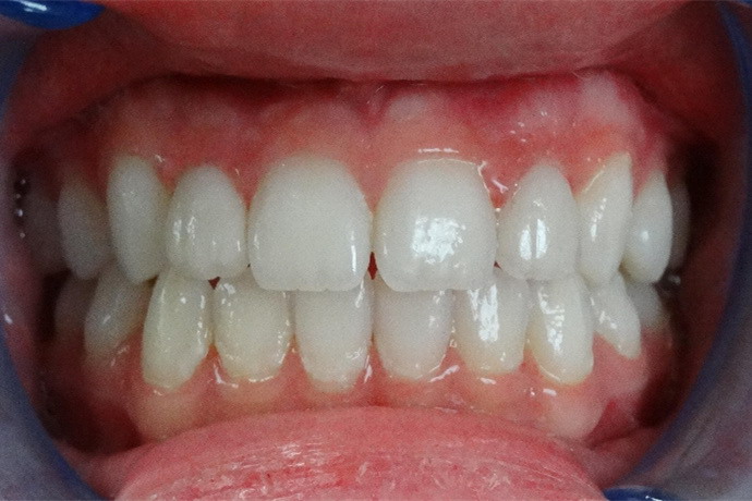 正常牙齿闭合图