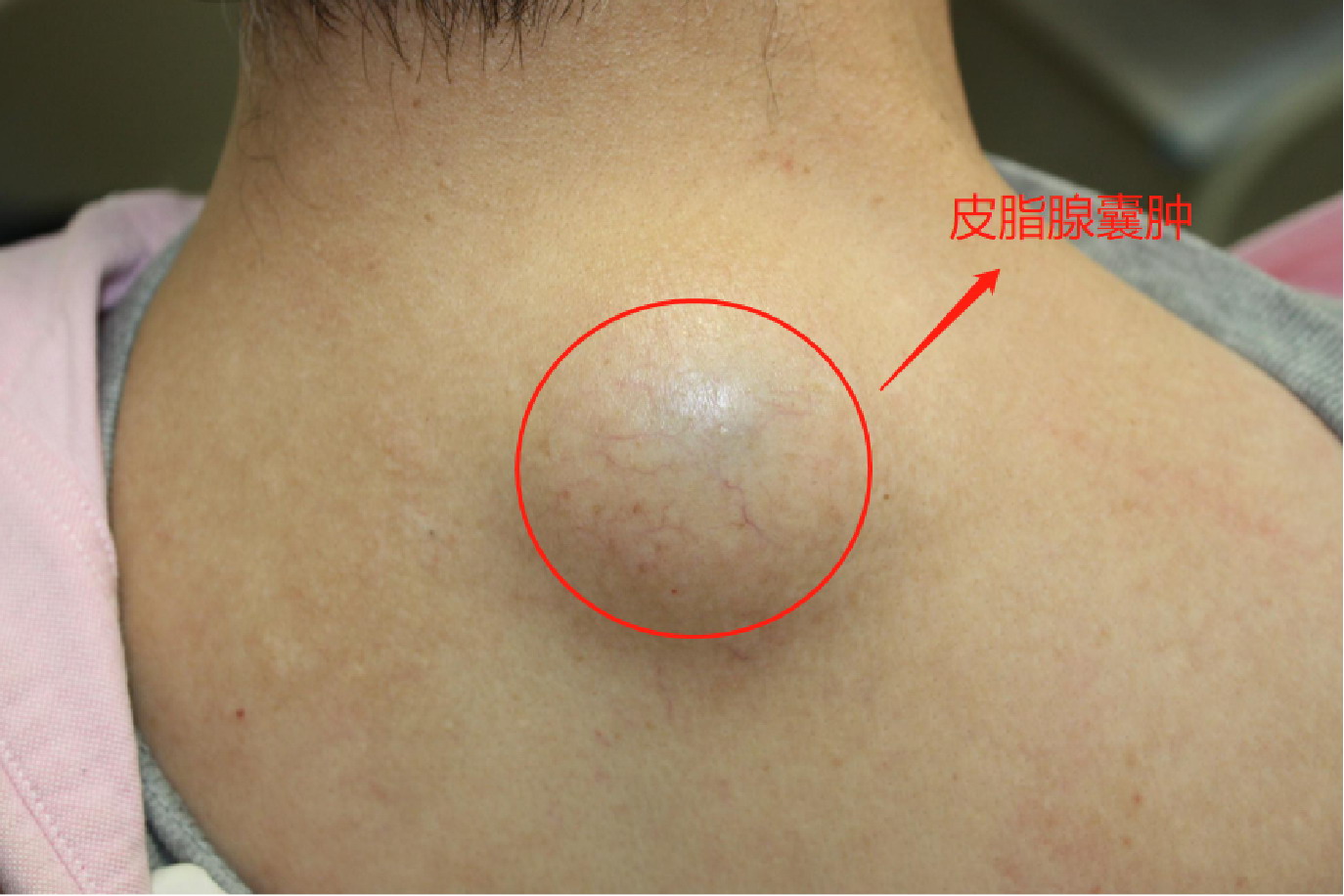 肩膀上凸起的皮脂腺囊肿图
