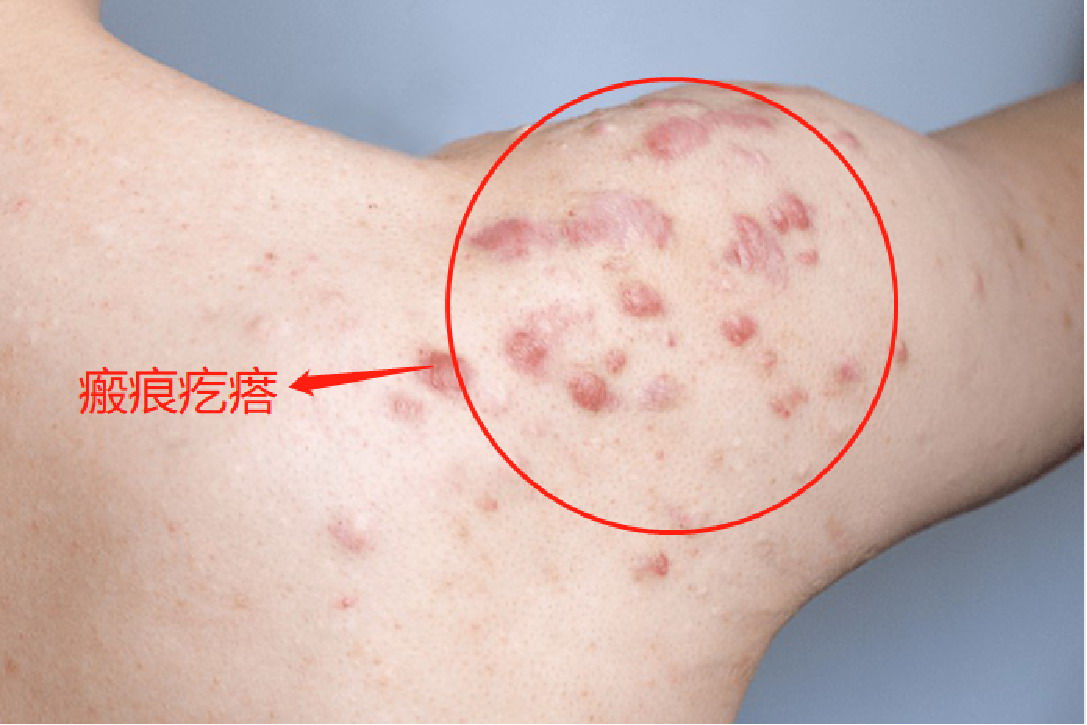 肩膀上凸起的瘢痕疙瘩图