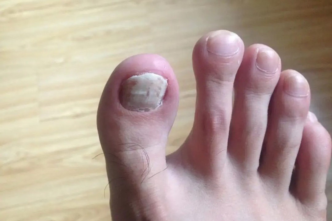 脚大拇趾发白