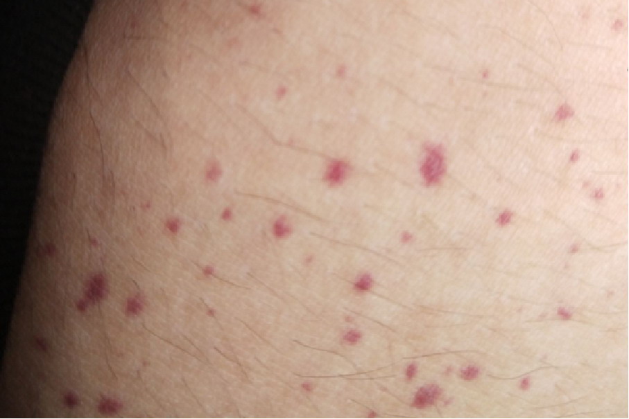 女性腹部过敏性紫癜图