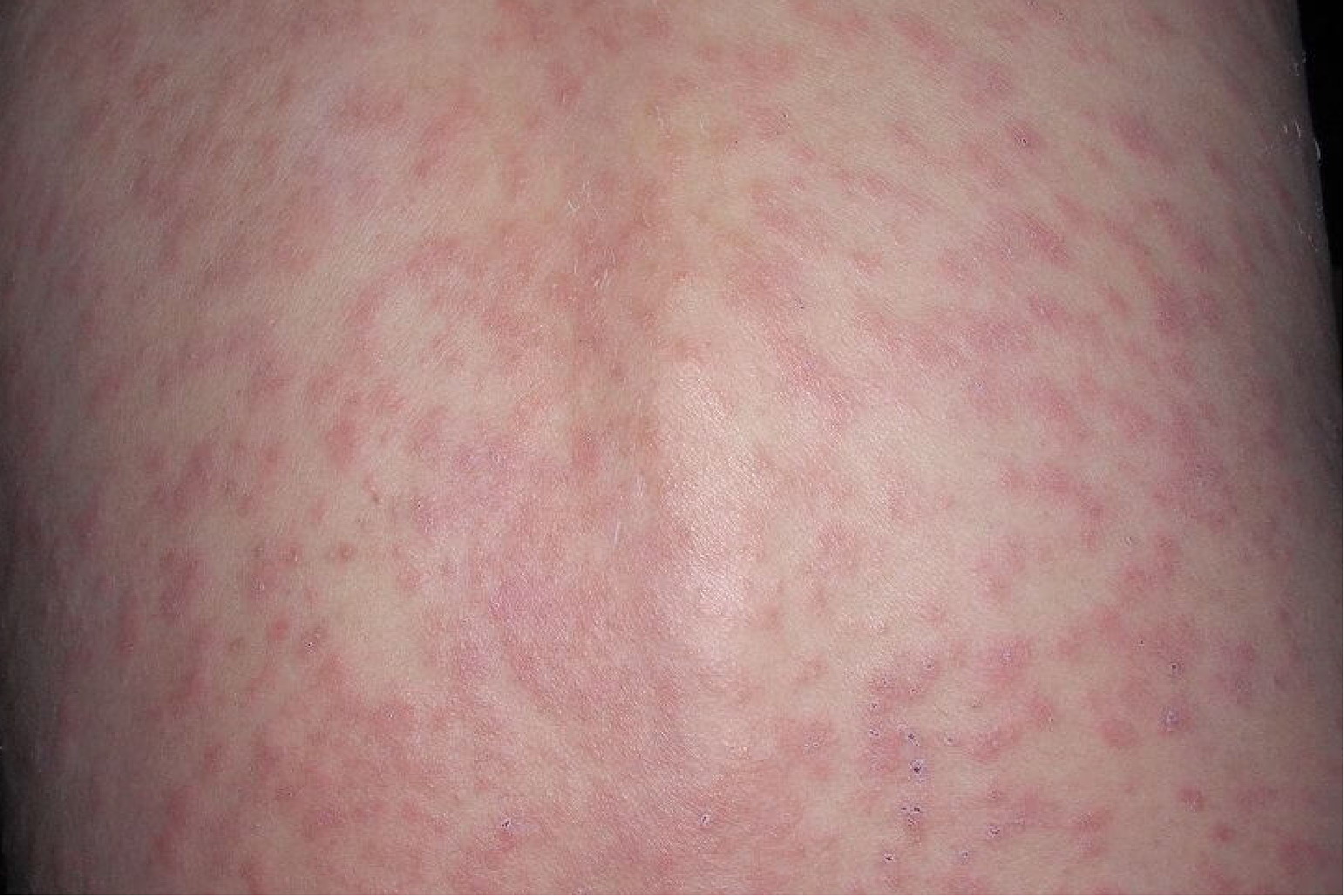 女性腹部湿疹图