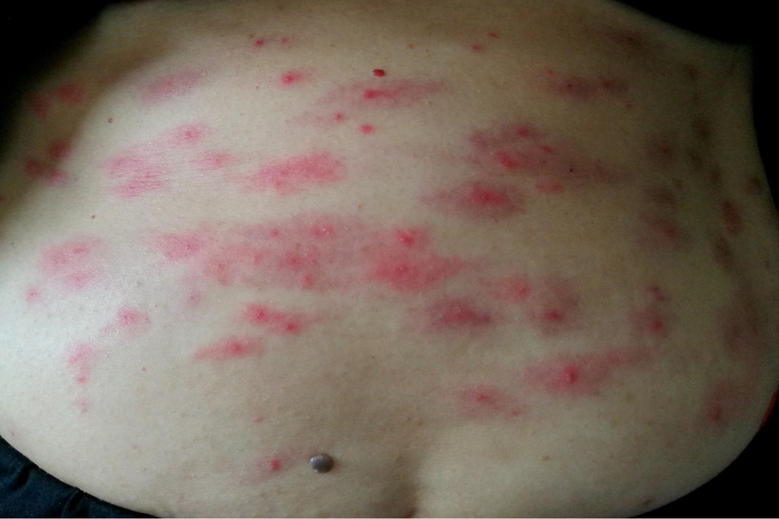 女性腹部虫咬反应图