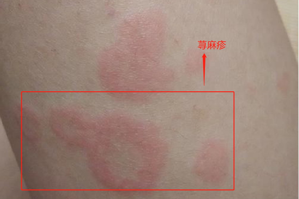 皮肤病荨麻疹图