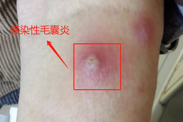 腿上的感染性毛囊炎图