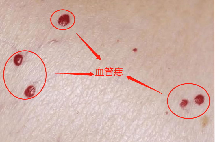 红色小血点-血管痣图