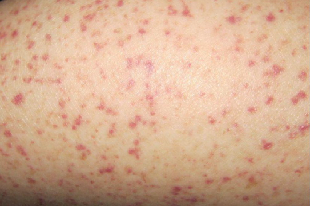 红色小血点-过敏性紫癜图