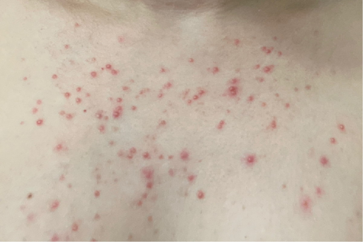 红色小血点-毛囊炎图