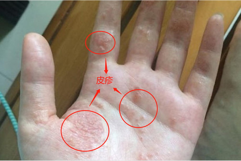 真菌感染手部出现皮疹图