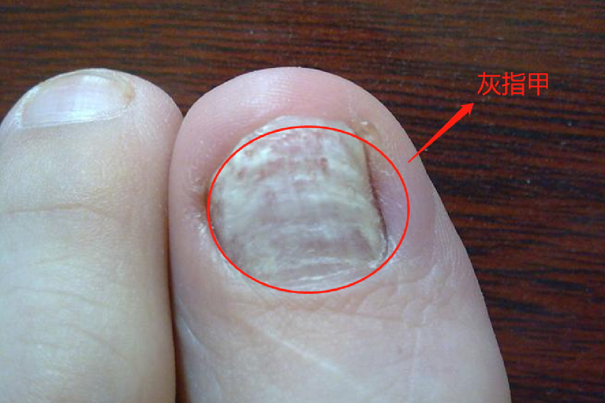 真菌感染手部出现指甲病变图