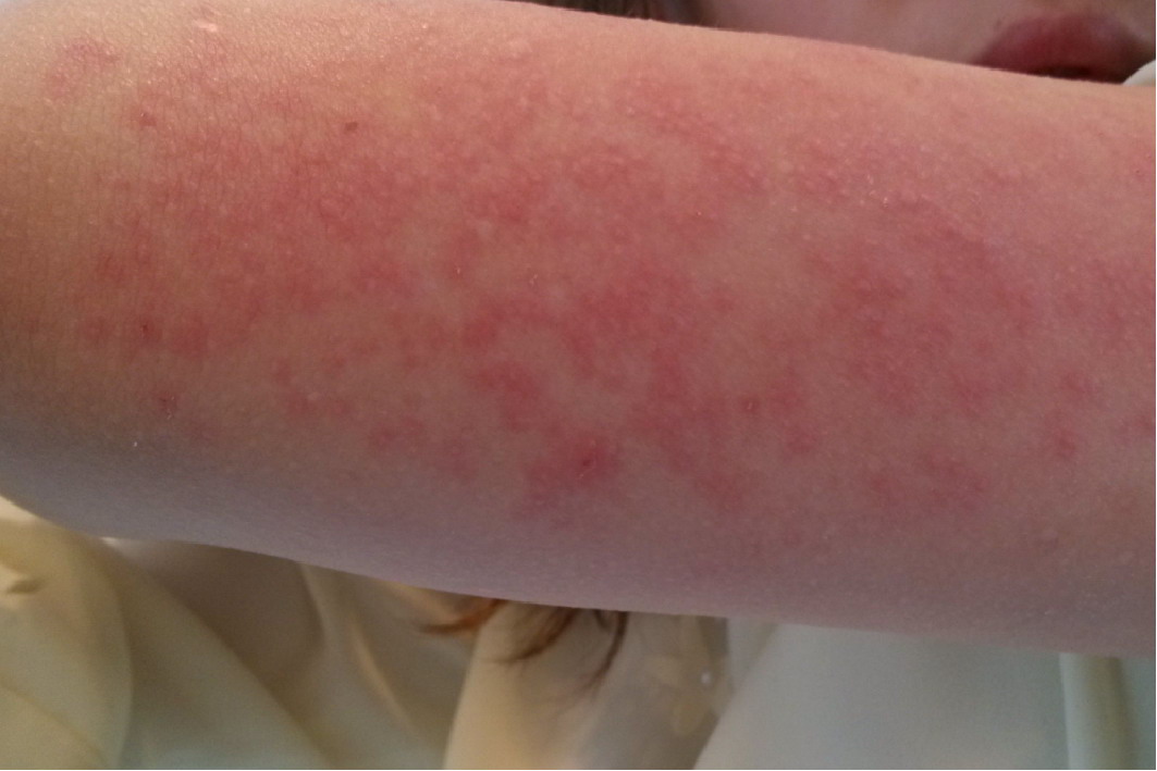 蛋白质过敏起丘疹