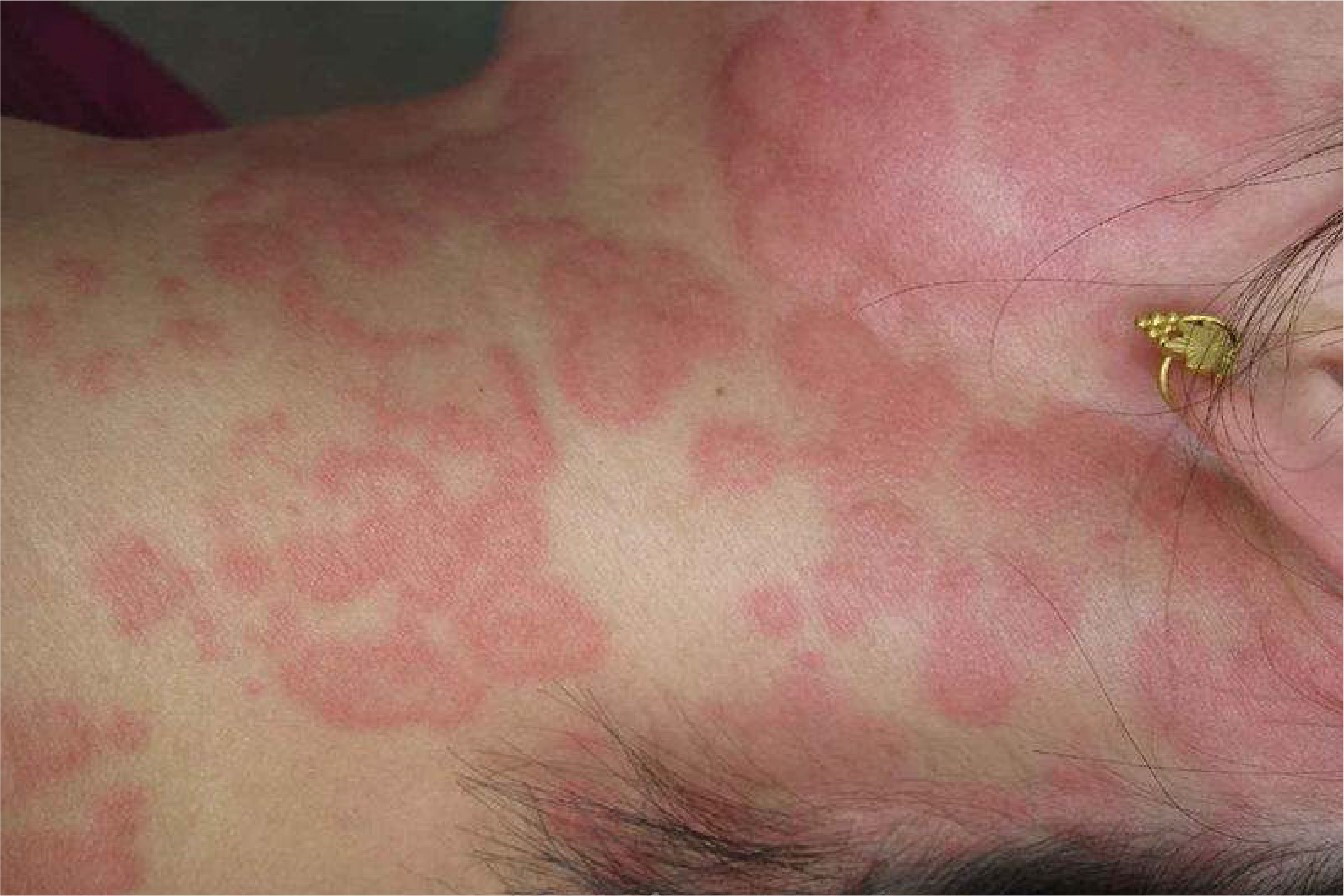 蛋白质过敏起风团样斑疹