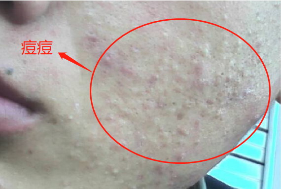 脸上的小米粒痘痘图