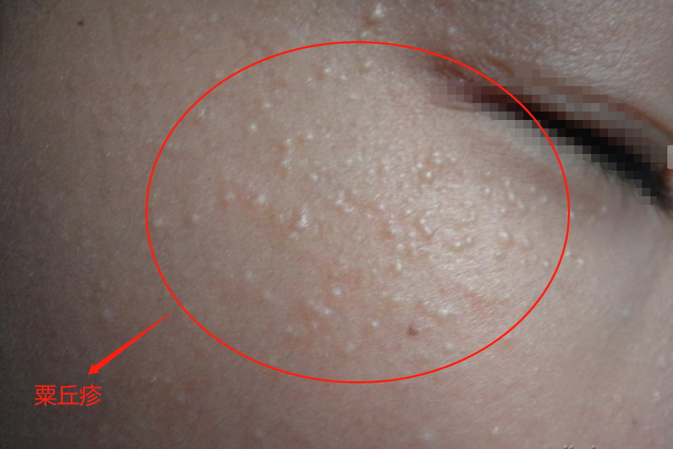 脸上的小米粒粟丘疹图