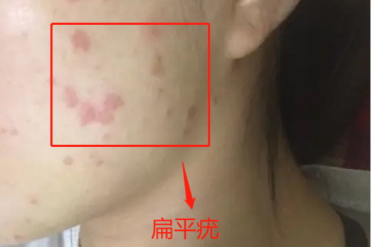 扁平疣图