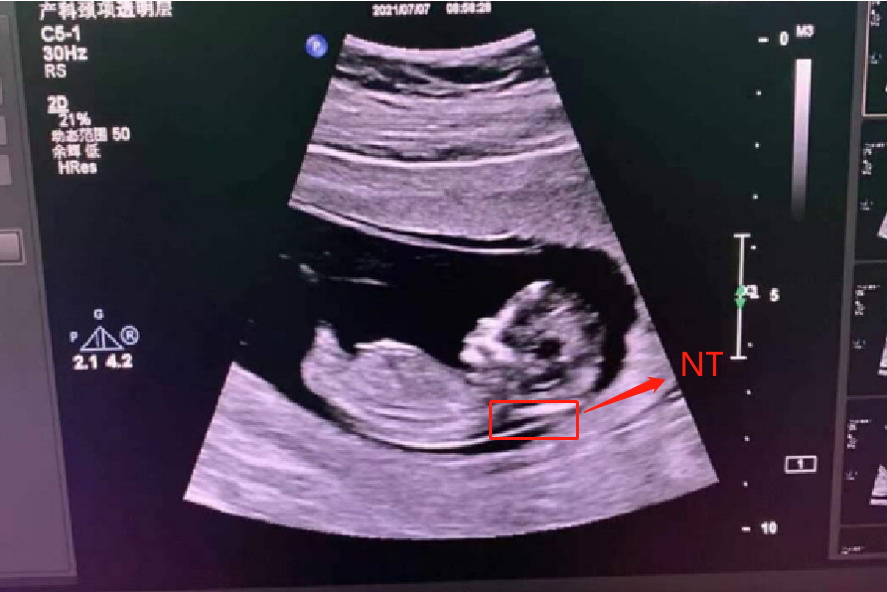 颈项透明层检查图片