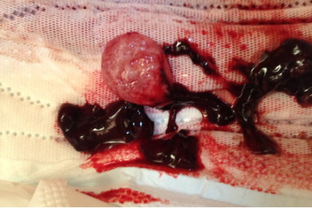 宫外孕流产排出物图