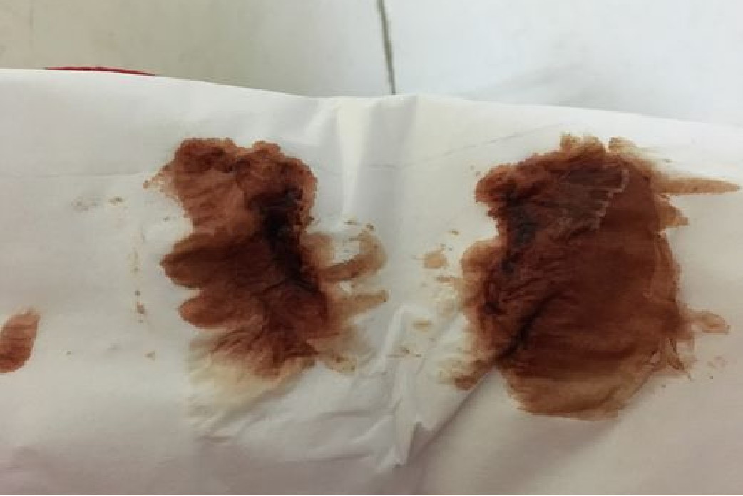 怀孕45天褐色液体图