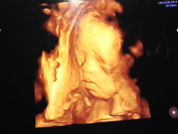 怀孕4个月四维彩超图