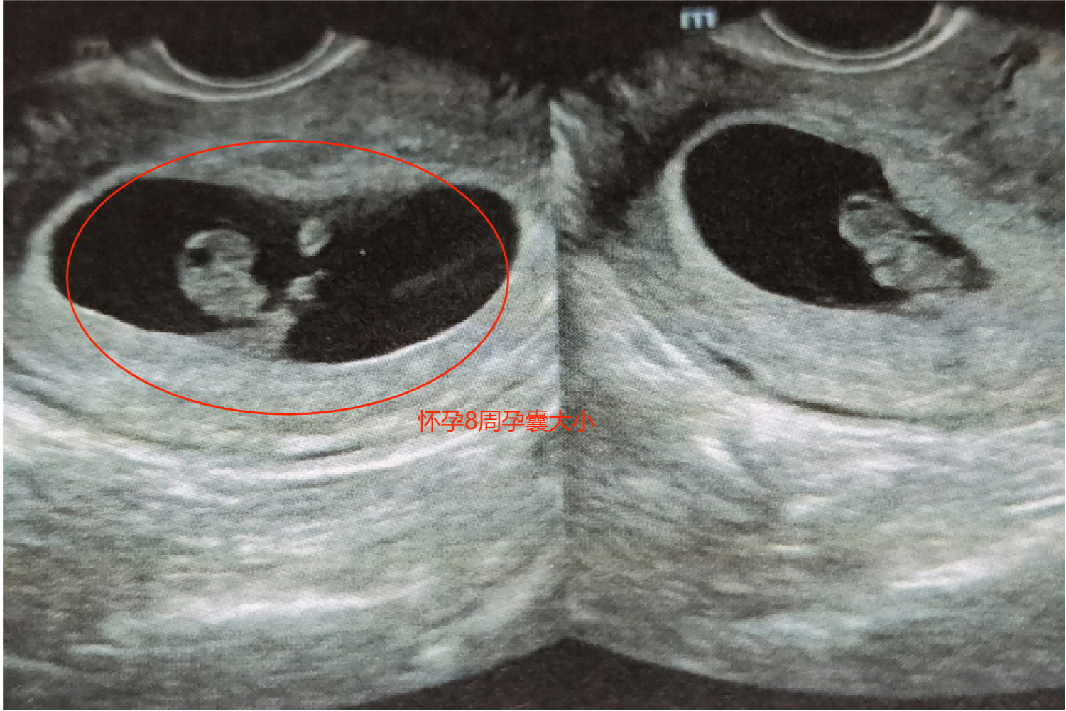 怀孕8周孕囊大小图