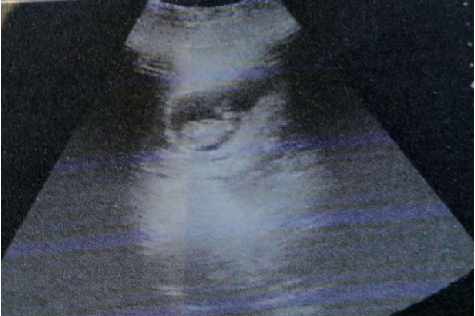 孕9周胎儿彩超图片