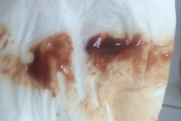 怀孕初期出血红褐色表现图