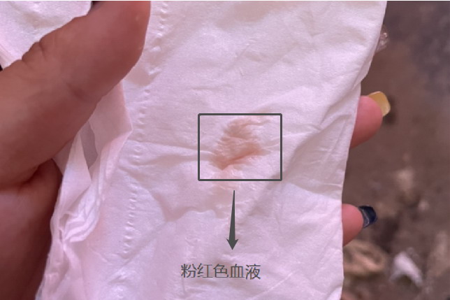 怀孕初期出血粉红色表现图