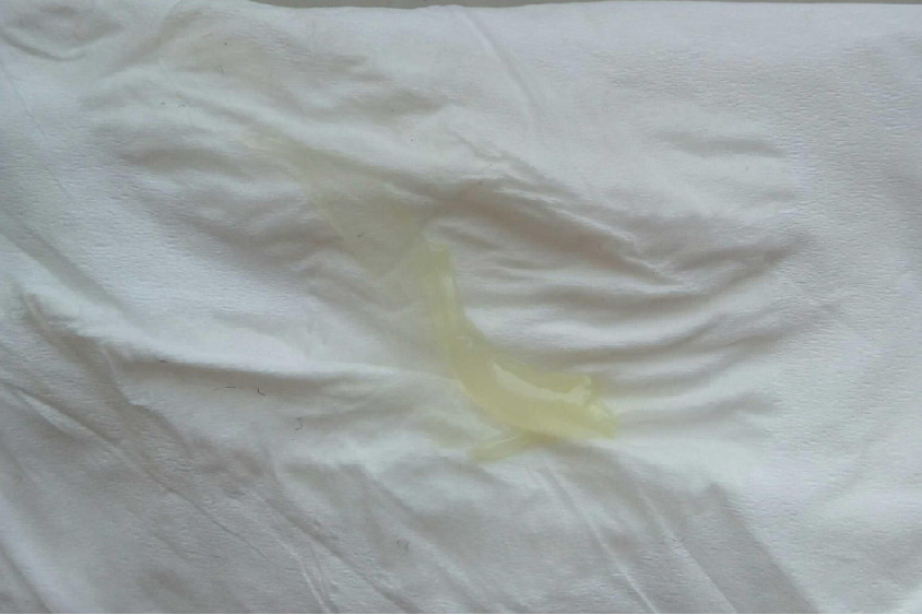 怀孕初期流黄水图片