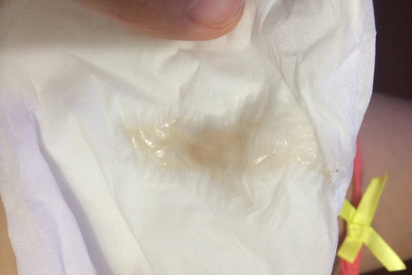 怀孕初期正常分泌物图