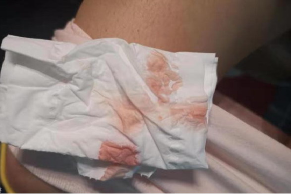 怀孕出鲜红色血液图