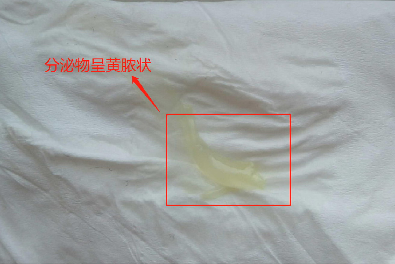 怀孕分泌物呈黄脓状图