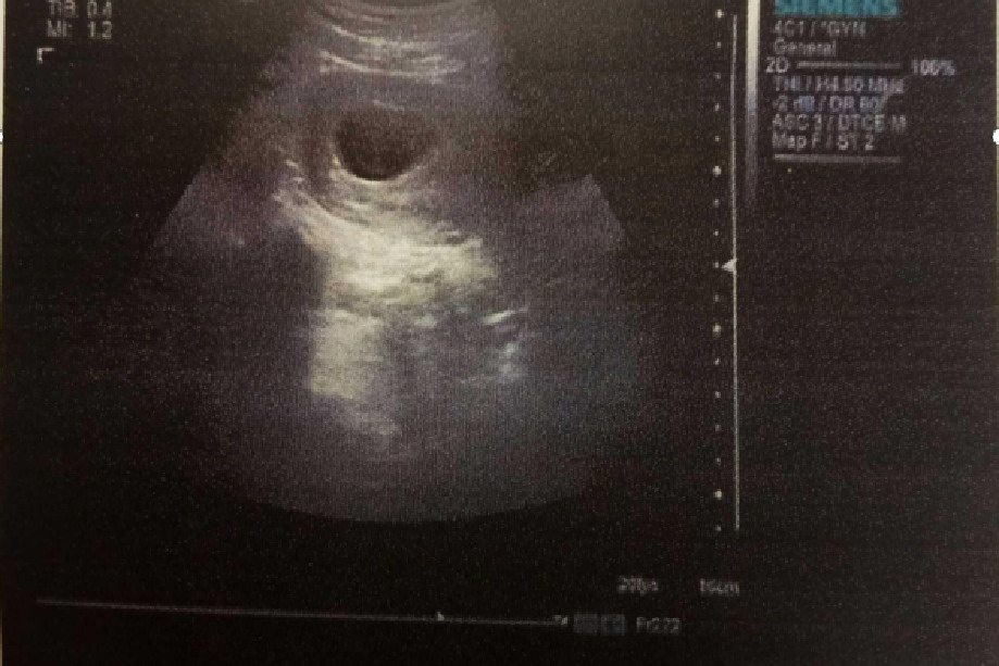 怀孕九周胎儿彩超真实图