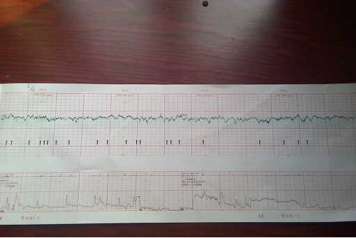 快生的宫缩曲线图