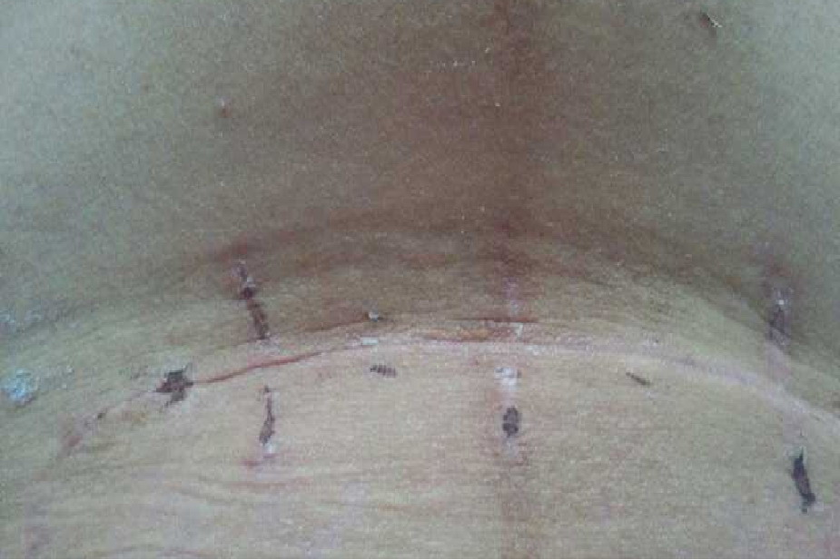 女人剖腹产疤痕图