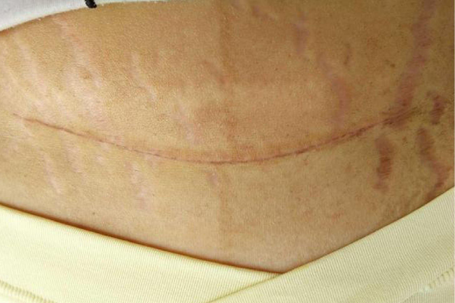 剖腹产刀口一个月恢复正常图